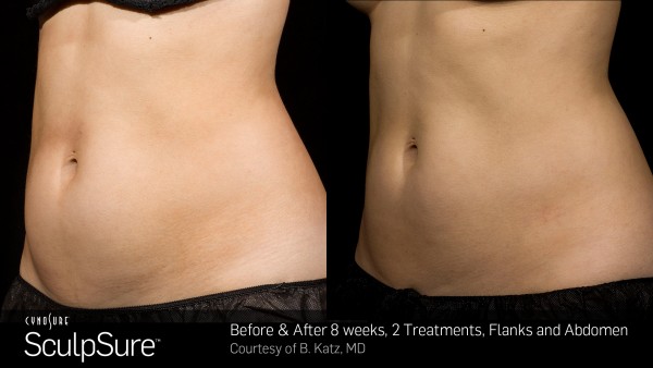 PRD-1342_BA_SculpSure_Katz_SBS_2tx_8wks_2