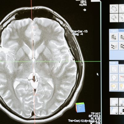 5 Ways Brain Injury Lawyers Can Help Victims Seek Justice