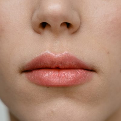 The Influence of Lip Fillers on Beauty Trends